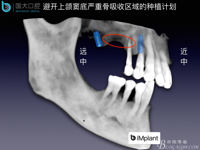 上頜竇底區(qū)域嚴重骨吸收的臨床種植案例.jpeg