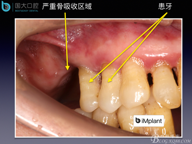 上頜竇底區(qū)域嚴重骨吸收的臨床種植案例.jpeg