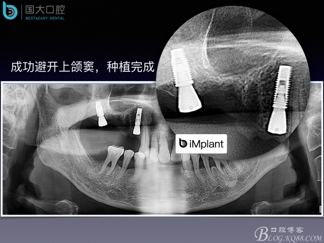 上頜竇底區(qū)域嚴重骨吸收的臨床種植案例.jpeg