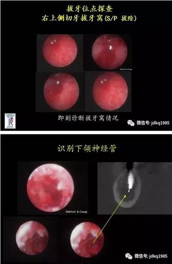 我院口腔種植科引進(jìn)國內(nèi)首臺(tái)口腔種植套管式微型內(nèi)窺鏡