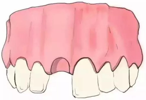 圖解：種牙與鑲牙的區(qū)別，缺牙的趕緊看.png