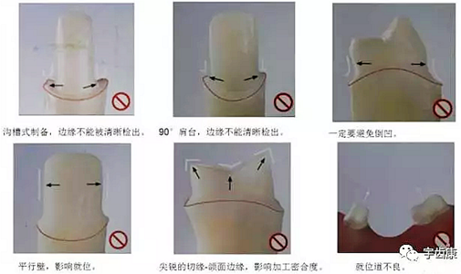 影響全瓷牙冠裂的因素有哪些？