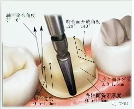 影響全瓷牙冠裂的因素有哪些？