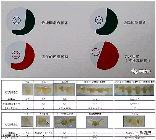 影響全瓷牙冠裂的因素有哪些？