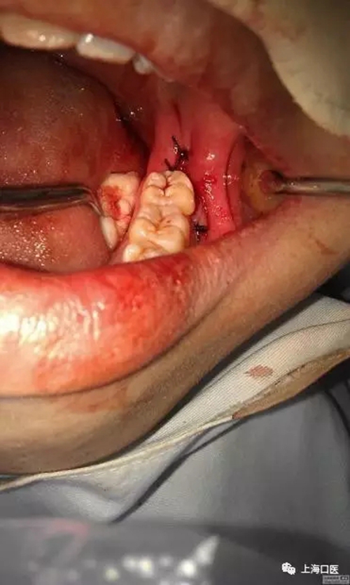 拔牙干槽癥可怕嗎？
