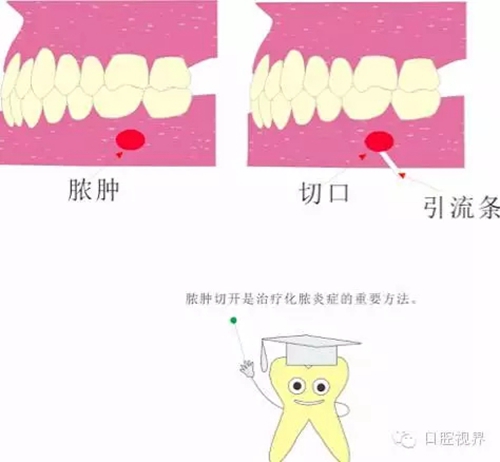 【愛(ài)牙科普知識(shí)300問(wèn)】 “什么是活髓切斷術(shù)？”