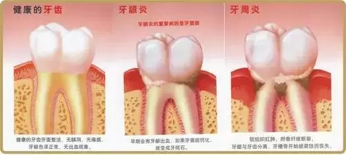 【康雅愛牙科普】牙周炎危害這么大，你咋還不著急呢？