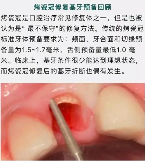 做全冠修復(fù)時基牙根面暴露，如何備牙？
