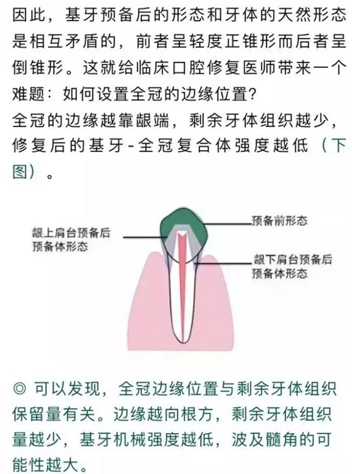 做全冠修復(fù)時基牙根面暴露，如何備牙？