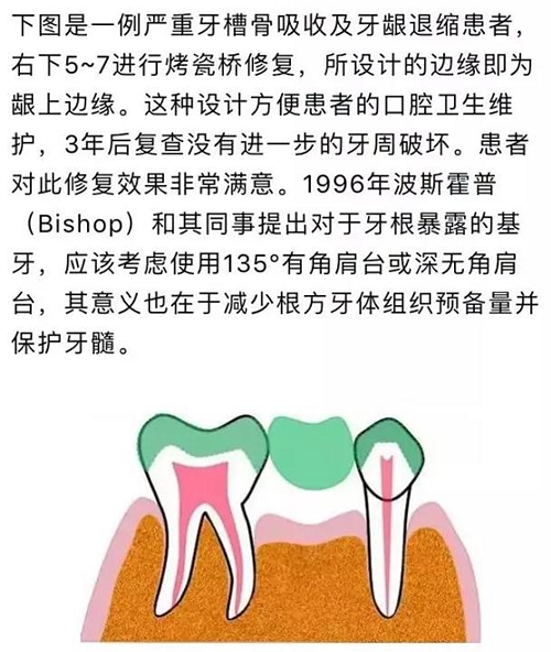 做全冠修復(fù)時基牙根面暴露，如何備牙？
