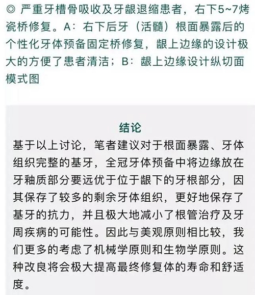 做全冠修復(fù)時基牙根面暴露，如何備牙？