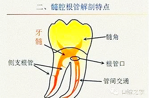 根管治療之根管口的探查要點  