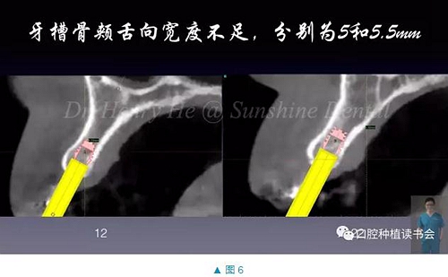 短種植體在前牙美學(xué)區(qū)應(yīng)用的臨床病例報道（上）