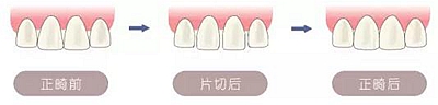 醫(yī)生方案里的鄰面去釉，究竟是什么？