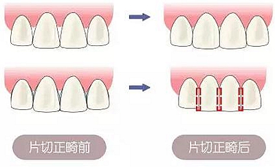 醫(yī)生方案里的鄰面去釉，究竟是什么？