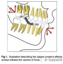 正畸文獻(xiàn)閱讀--用Jasper跳躍矯治器治療II類(lèi)患者的長(zhǎng)期穩(wěn)定性