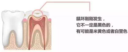 【收藏】關(guān)于補(bǔ)牙，知道這些就夠了！