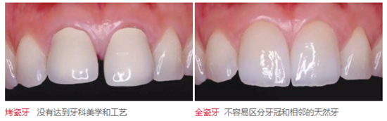 醫(yī)生，我的烤瓷牙上有個(gè)黑線怎么回事？