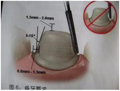 醫(yī)生，我的烤瓷牙上有個(gè)黑線怎么回事？