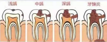 當心“腹黑”齲齒，牙齒有個小洞也要補！