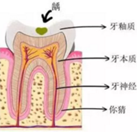 當心“腹黑”齲齒，牙齒有個小洞也要補！