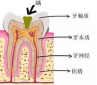 當心“腹黑”齲齒，牙齒有個小洞也要補！