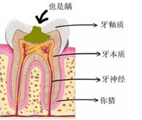當心“腹黑”齲齒，牙齒有個小洞也要補！