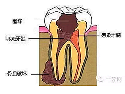 詳解牙疼的原因分幾種？