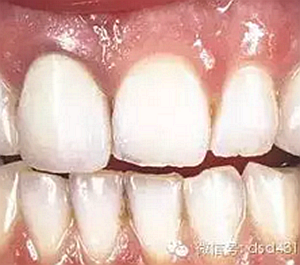 是什么導(dǎo)致了義齒返工？