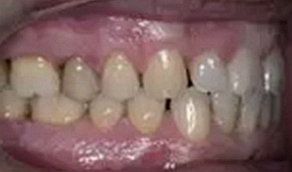 個(gè)案報(bào)導(dǎo)--牙列取模后下頜骨舌側(cè)壞死