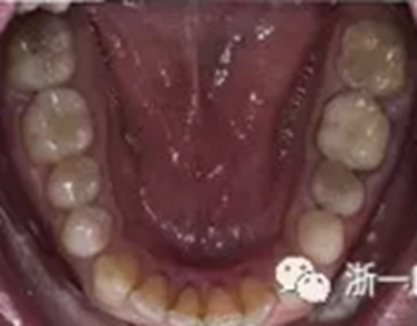 個(gè)案報(bào)導(dǎo)--牙列取模后下頜骨舌側(cè)壞死