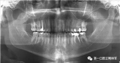 個(gè)案報(bào)導(dǎo)--牙列取模后下頜骨舌側(cè)壞死