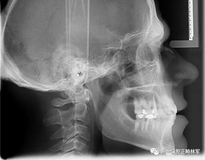 個(gè)案報(bào)導(dǎo)--牙列取模后下頜骨舌側(cè)壞死