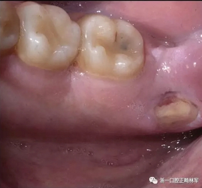 個(gè)案報(bào)導(dǎo)--牙列取模后下頜骨舌側(cè)壞死