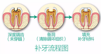 完全不懂，各種補牙材料，到底怎么選？