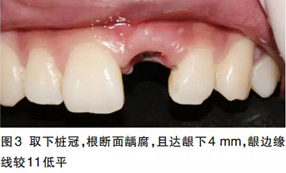 前牙即刻種植并個性化基臺美學(xué)修復(fù)