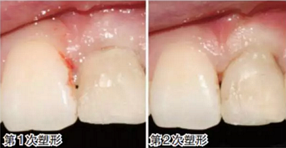 前牙即刻種植并個性化基臺美學(xué)修復(fù)