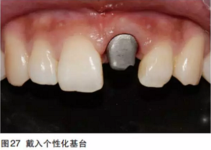 前牙即刻種植并個性化基臺美學(xué)修復(fù)