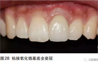 前牙即刻種植并個性化基臺美學(xué)修復(fù)