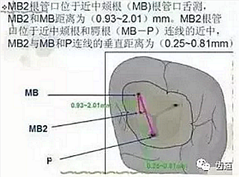 根管治療常見(jiàn)的難點(diǎn)與解決方案
