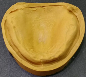 口腔患者的福音，卓逸精品工作室吸附性義齒案例鑒賞