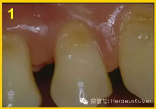 簡(jiǎn)單治療——格魯瑪脫敏劑的應(yīng)用
