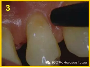 簡(jiǎn)單治療——格魯瑪脫敏劑的應(yīng)用