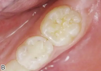 預(yù)防齲齒，口腔醫(yī)生能幫我做什么？局部用氟、窩溝封閉、預(yù)防性樹脂充填都是什么？