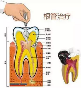 醫(yī)生，牙齒折斷不是應(yīng)該補上去嗎，為啥要做根管治療？