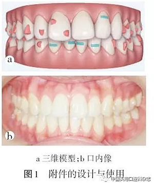 專題筆談 | 無托槽隱形矯治技術(shù)
