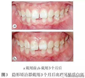 專題筆談 | 無托槽隱形矯治技術(shù)