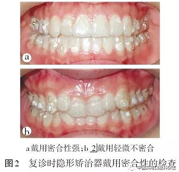 專題筆談 | 無托槽隱形矯治技術(shù)