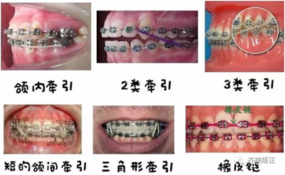 牙齒矯正，為什么要掛橡皮筋？