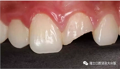 成人牙齒外傷了怎么應(yīng)急處理？